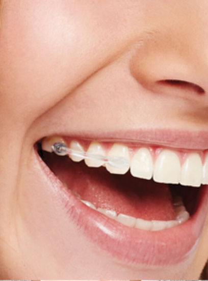 Functional appliance FAQs