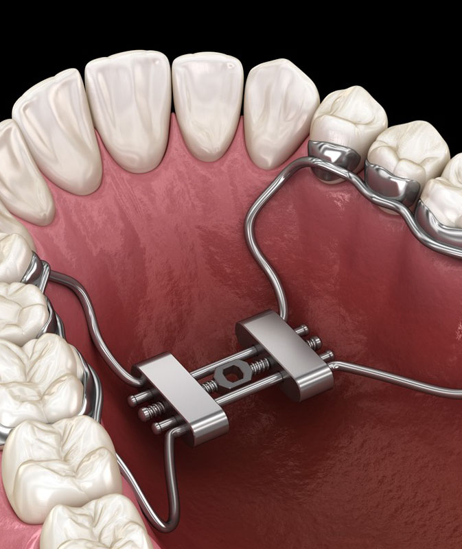 What are functional appliances?