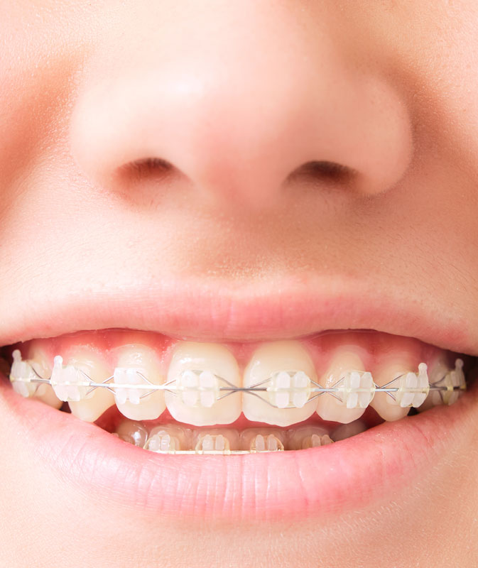 Clarity Advanced clear braces