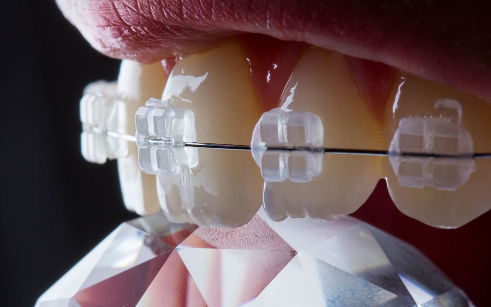 How Much Do Braces Cost in Scotland? An Updated Guide for 2025